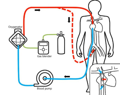 medical circulation pump