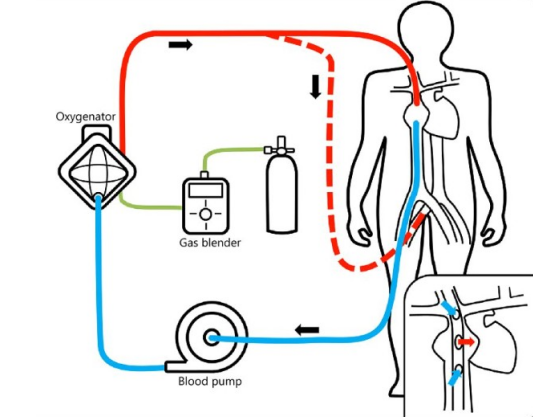 ECMO heat exchange tank pump